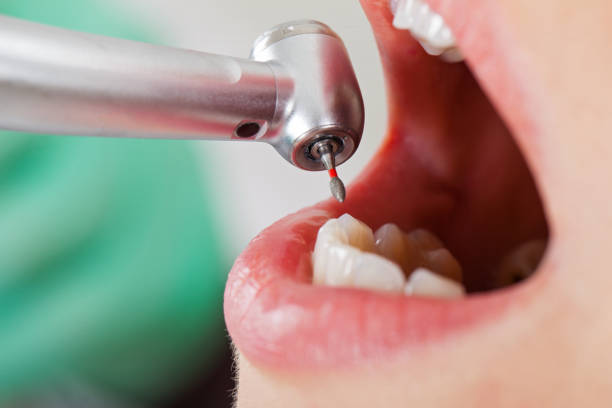 Best Emergency Dental Extractions in La Villa, TX